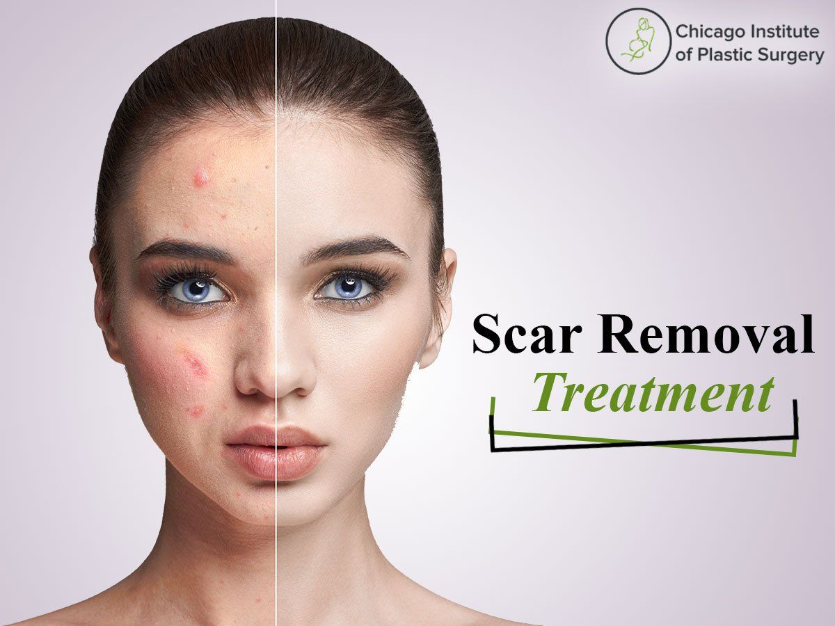 Best Treatments For The Removal Of Scar And Make Your Skin Smooth 9546