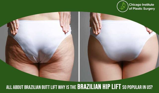 Why Is The Brazilian Hip Lift So Popular In US? All About
