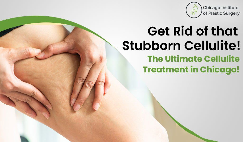 Get Rid of that Stubborn Cellulite! The Ultimate Cellulite Treatment in Chicago