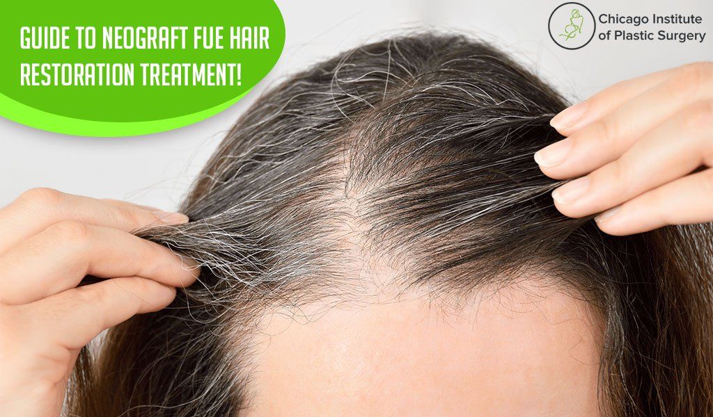 Guide To NeoGraft FUE Hair Restoration Treatment in Chicago