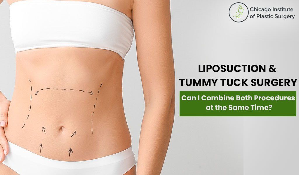 Liposuction & Tummy Tuck Surgery---Can I Combine Both Procedures at the  Same Time?