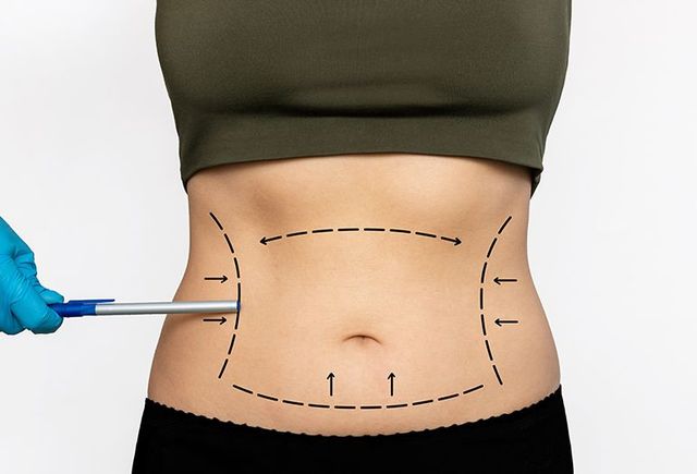 Which Body Contouring Option Suits You Best? Tummy Tuck or Liposuction?