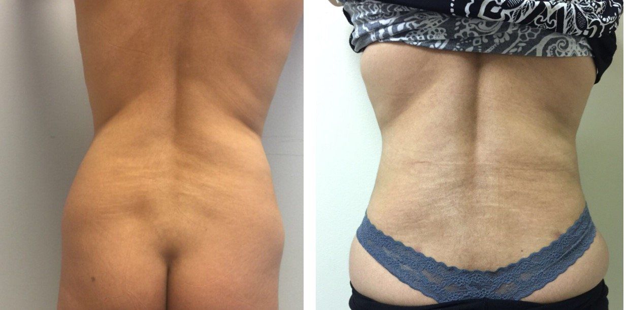 A before and after picture of a woman 's back.