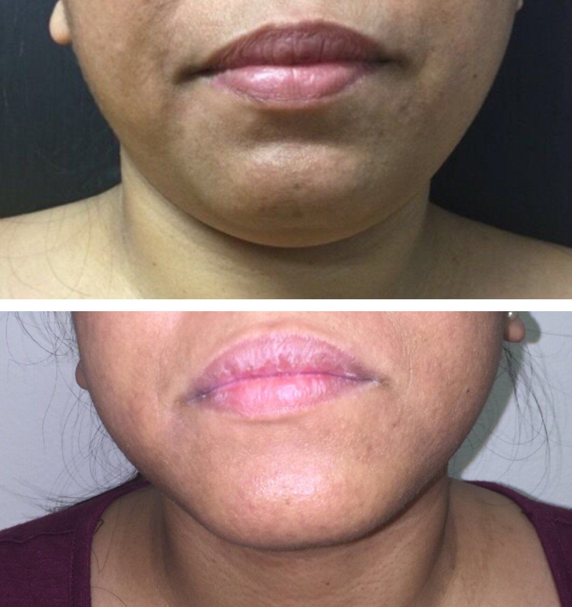 A before and after photo of a woman 's neck and lips