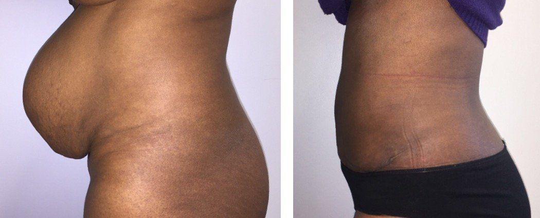 A before and after picture of a woman 's stomach.