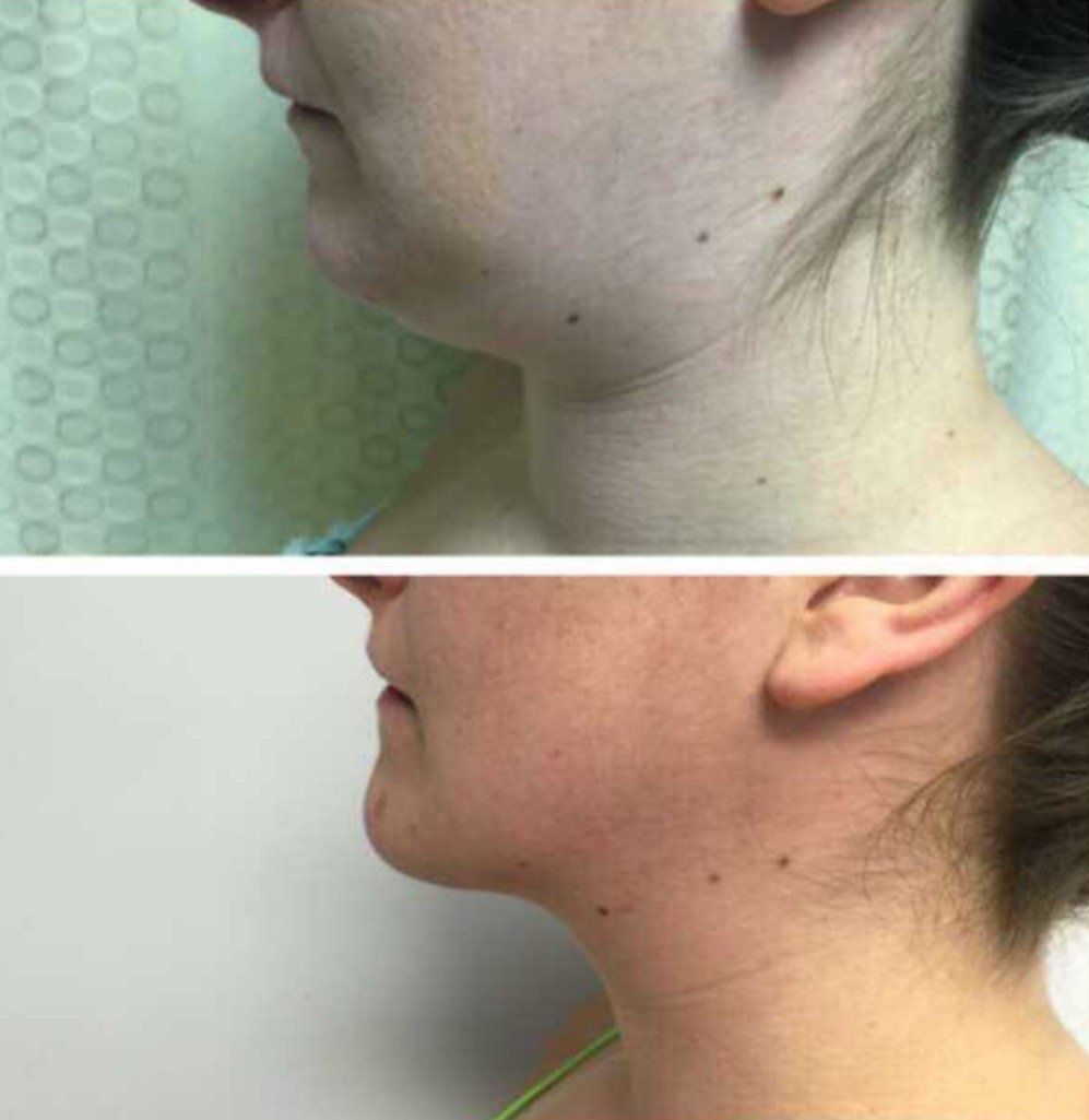 A before and after photo of a woman 's neck and face.
