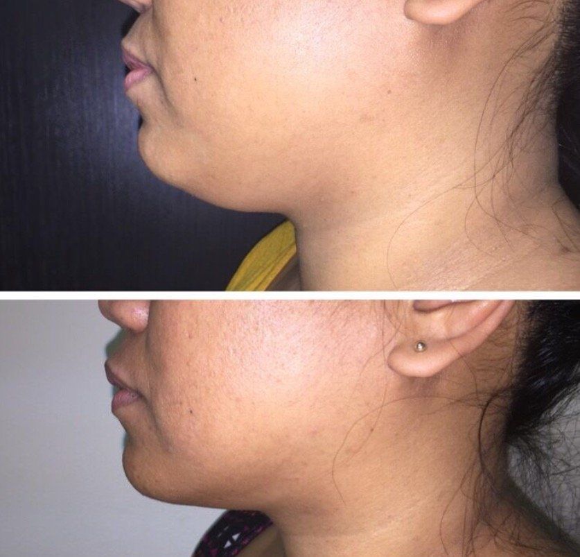 A before and after photo of a woman 's neck and ear