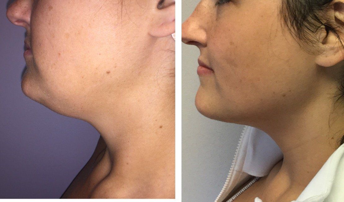 A before and after photo of a woman 's neck and face.