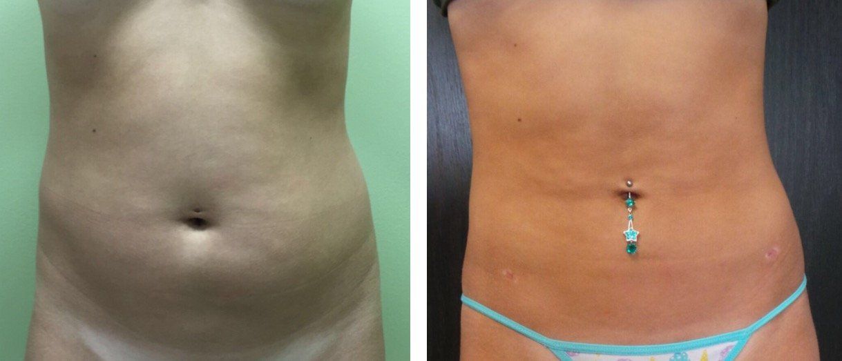 A before and after picture of a woman 's stomach.