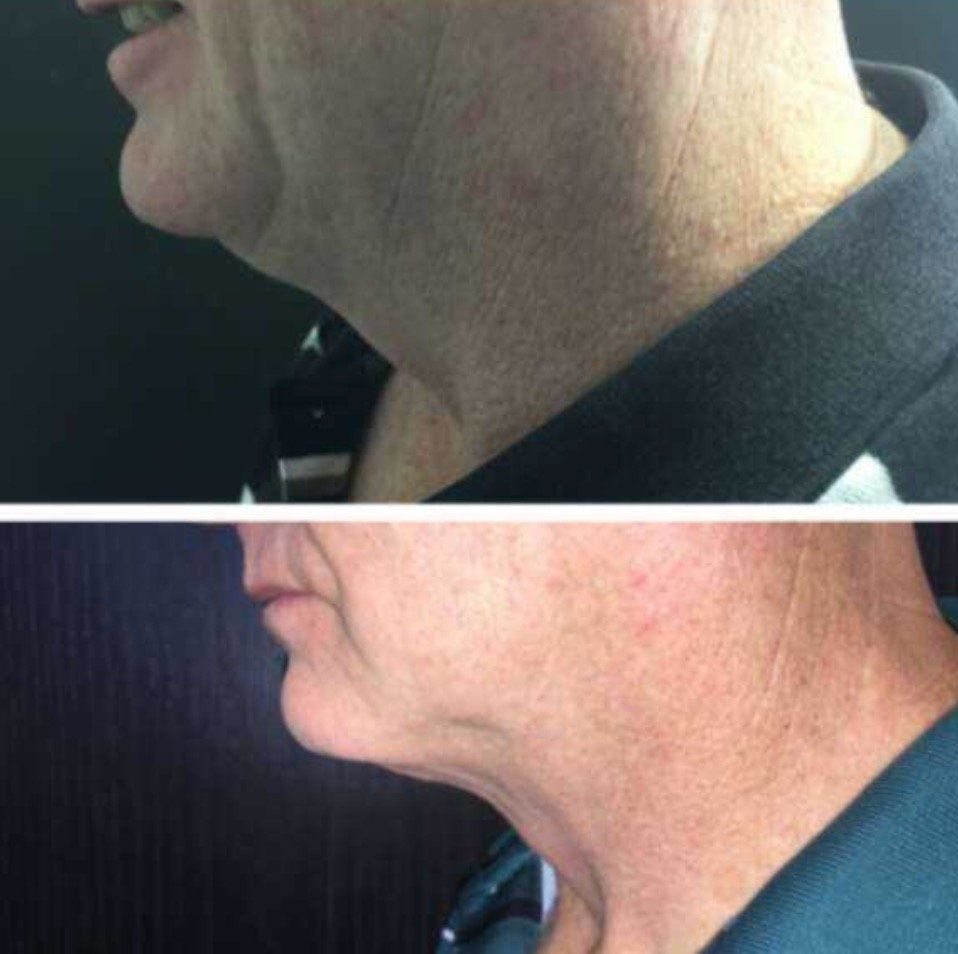 A before and after picture of a man 's neck