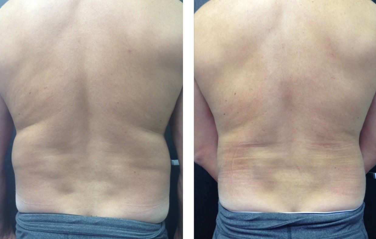 A before and after picture of a man 's back.