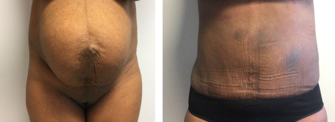 A before and after picture of a woman 's stomach.