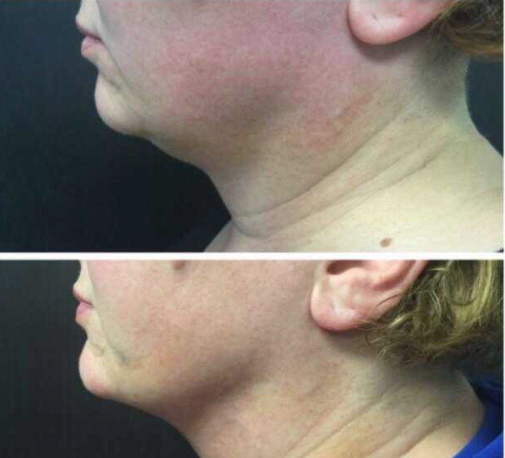 A before and after photo of a woman 's neck and face