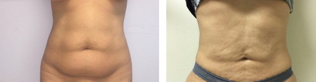 A before and after picture of a woman 's stomach.