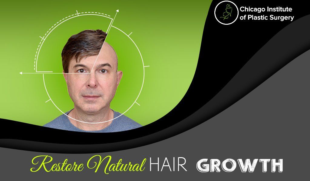 Hair Transplant Surgery – To Restore Natural Hair Growth