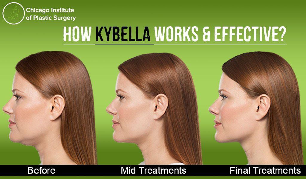 How Kybella works and why it is so effective