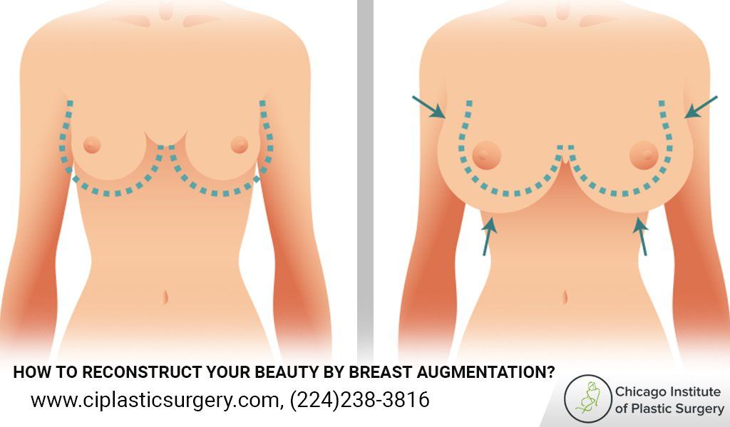 Breast Augmentation - Perfect options to get Breast size and shape