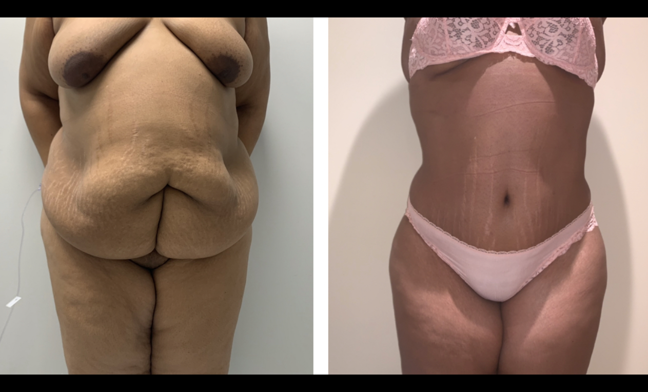 A before and after picture of a woman 's stomach