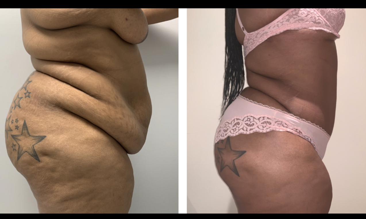 A woman 's stomach is shown before and after surgery.
