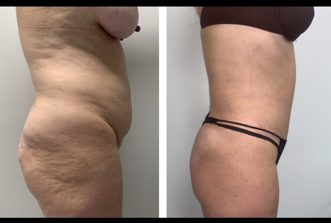 A woman 's torso is shown before and after surgery.