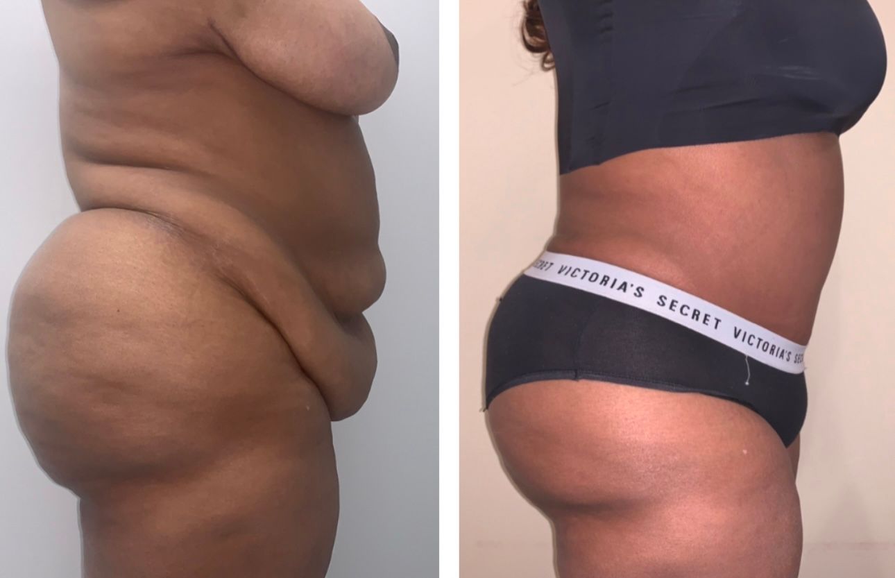 A before and after photo of a woman 's body