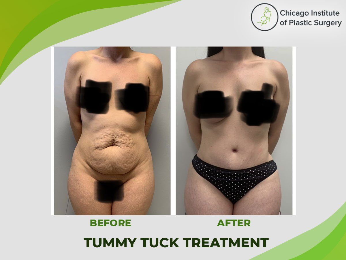 Reduce Your Belly Fat with Tummy Tuck Treatment