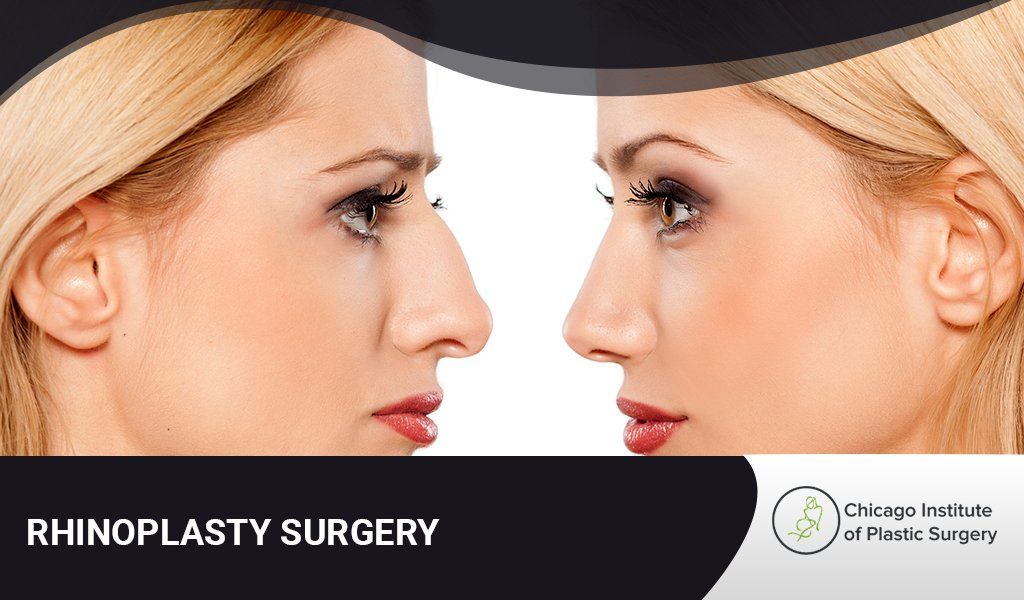 Before and After Rhinoplasty Surgery 
