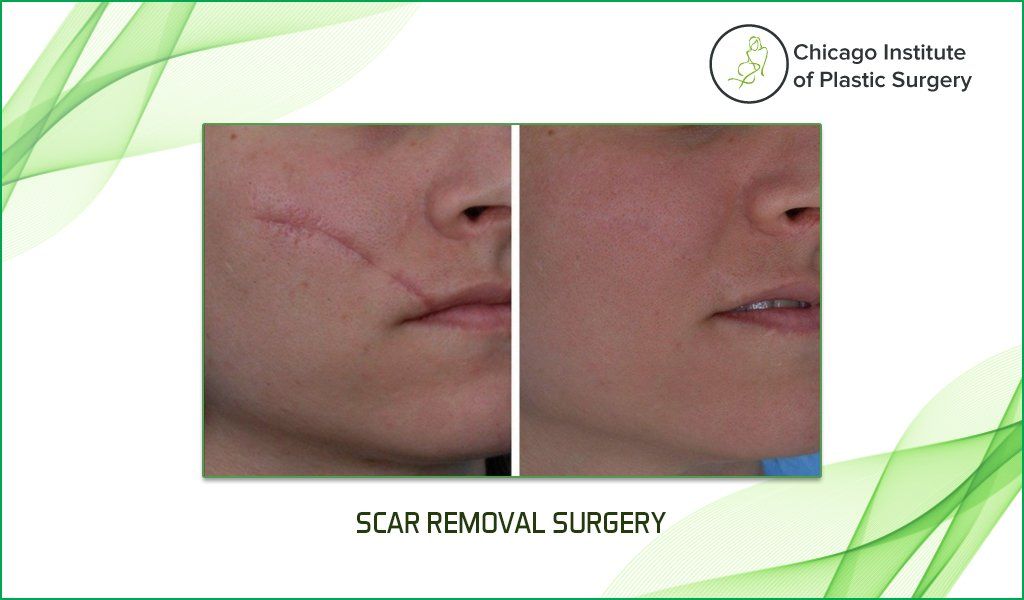 Before and After Scar Removal Surgery