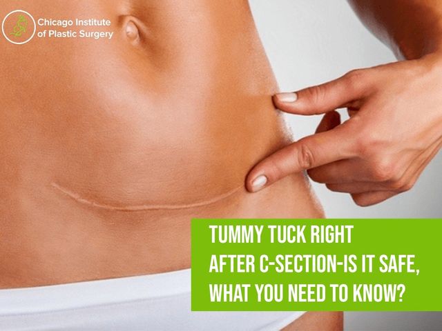 How Safe Is Tummy Tuck Right After C-section? What You Need to Know?