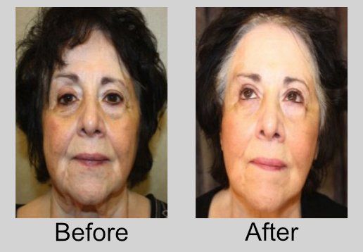 A before and after photo of a woman 's face