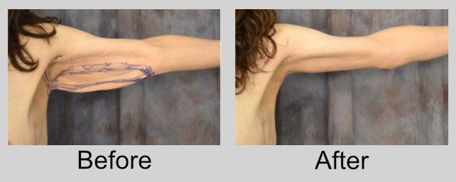 A before and after picture of a woman 's arm