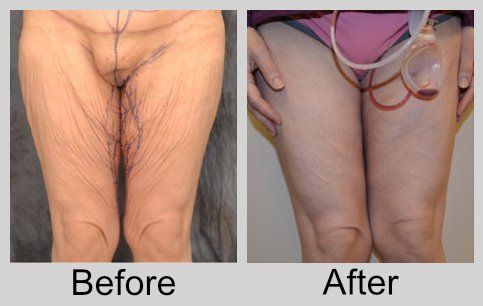 A before and after photo of a woman 's legs and thighs
