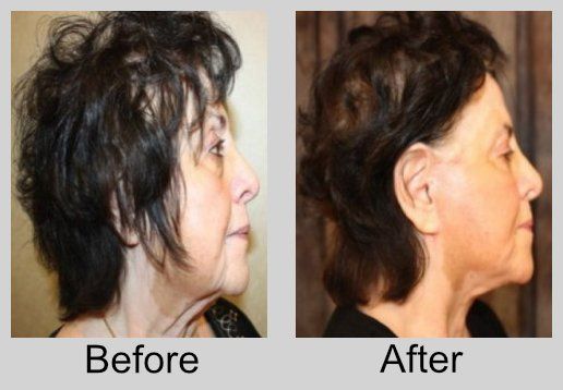 A before and after photo of a woman 's face