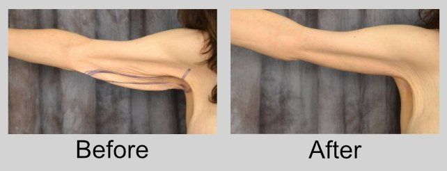 A before and after picture of a woman 's arms.