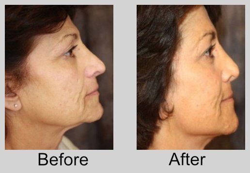 A before and after photo of a woman 's face