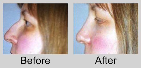 A before and after picture of a woman 's nose.