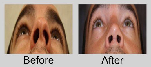 A before and after picture of a person 's nose