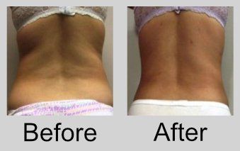 A before and after picture of a woman 's back