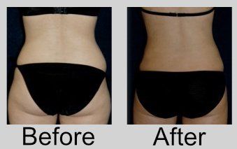 A before and after picture of a woman 's back