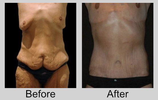 A before and after picture of a woman 's stomach