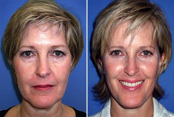 A before and after photo of a woman 's face