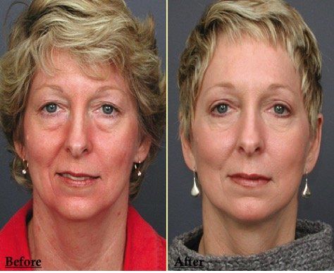 A before and after photo of a woman 's face