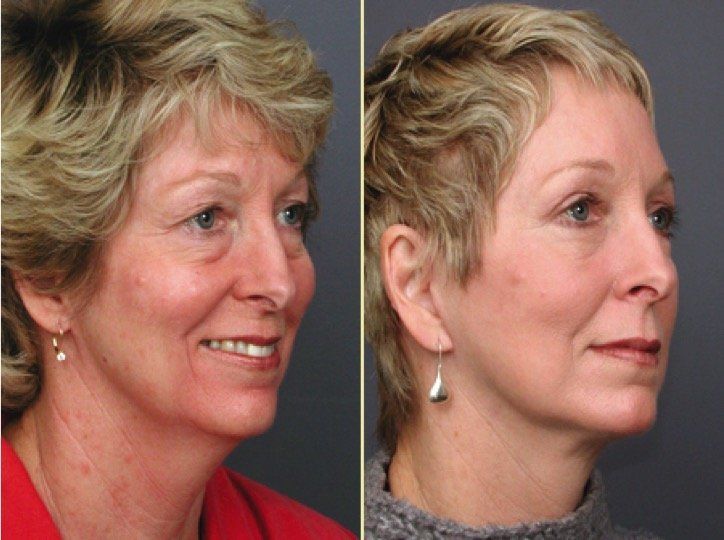 A before and after photo of a woman 's face.