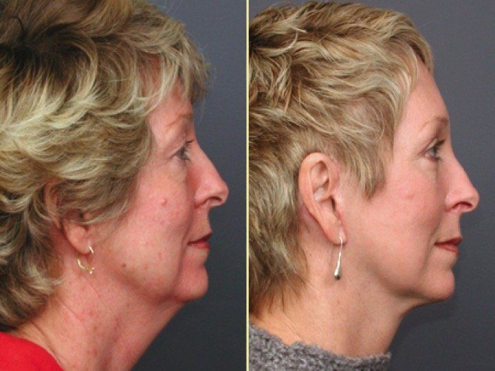 A before and after photo of a woman 's neck and face.