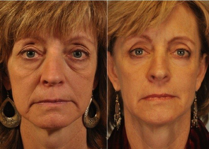 A before and after photo of a woman 's face