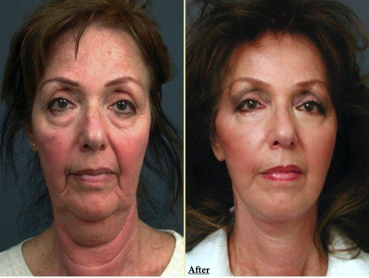 A before and after photo of a woman 's face