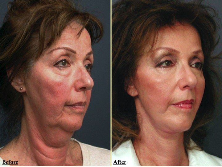A before and after photo of a woman 's face