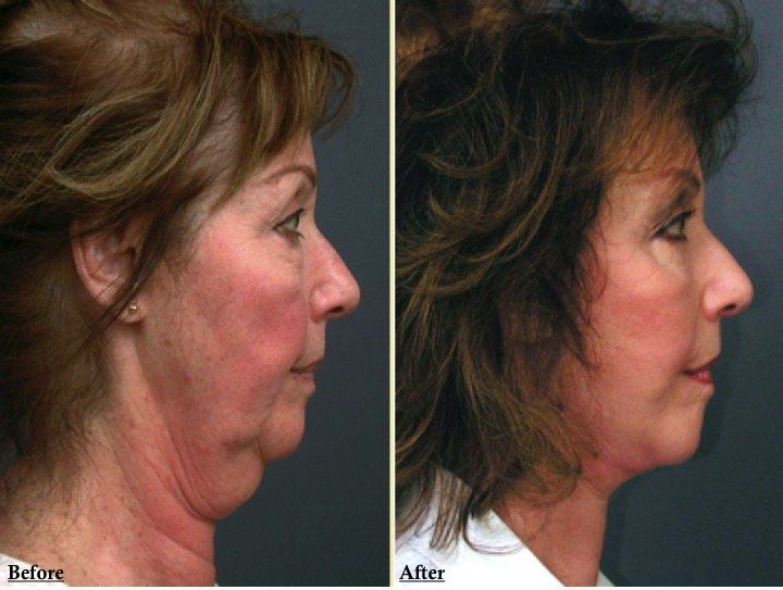 A before and after photo of a woman 's face