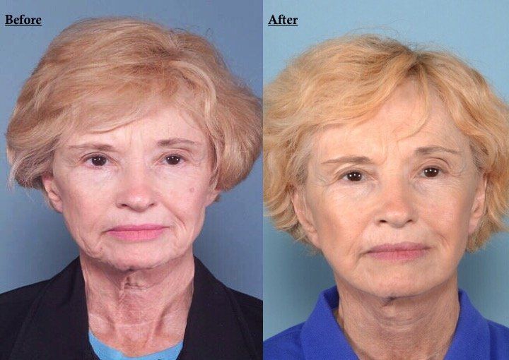 A before and after photo of a woman 's face