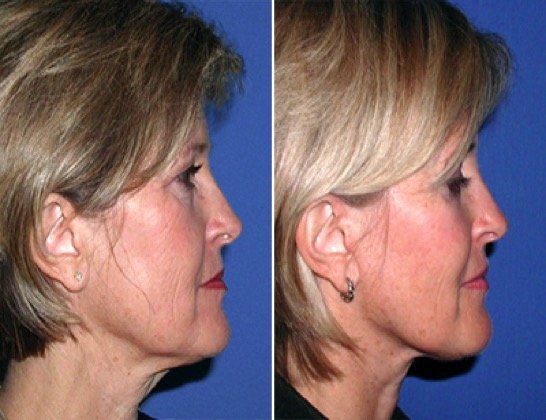 A before and after photo of a woman 's face and neck